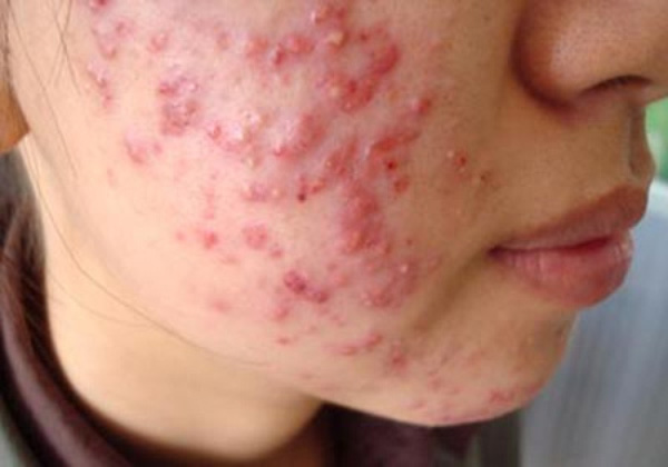 kem trị mụn tốt kem trị mụn tốt