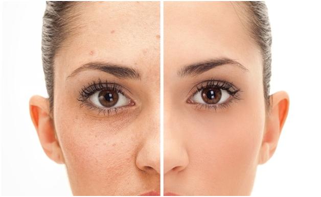kem trị mụn hiệu quả nhất hiện nay