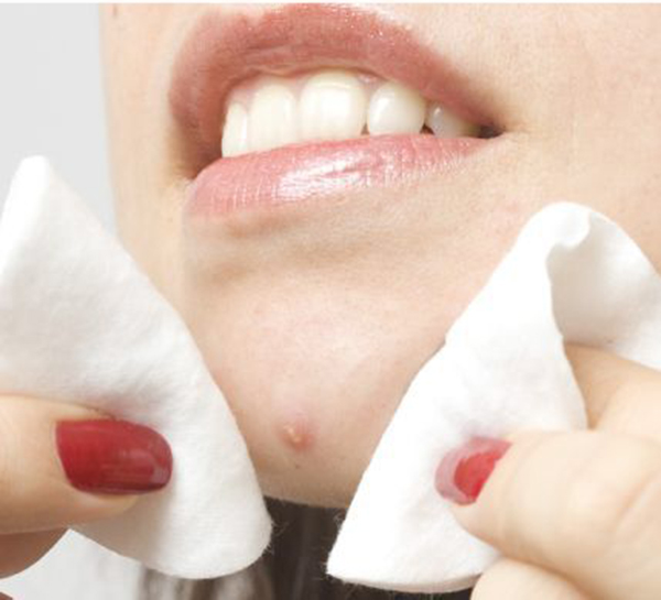 mẹo trị mụn bọc