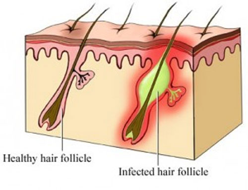 cách chữa bệnh viêm lỗ chân lông