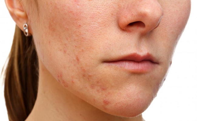 thuốc đặc trị viêm nang lông