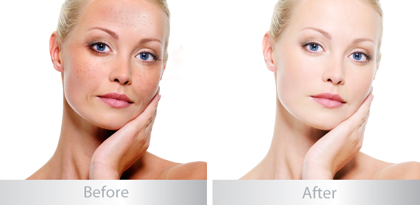 Kem trị nám tốt nhất