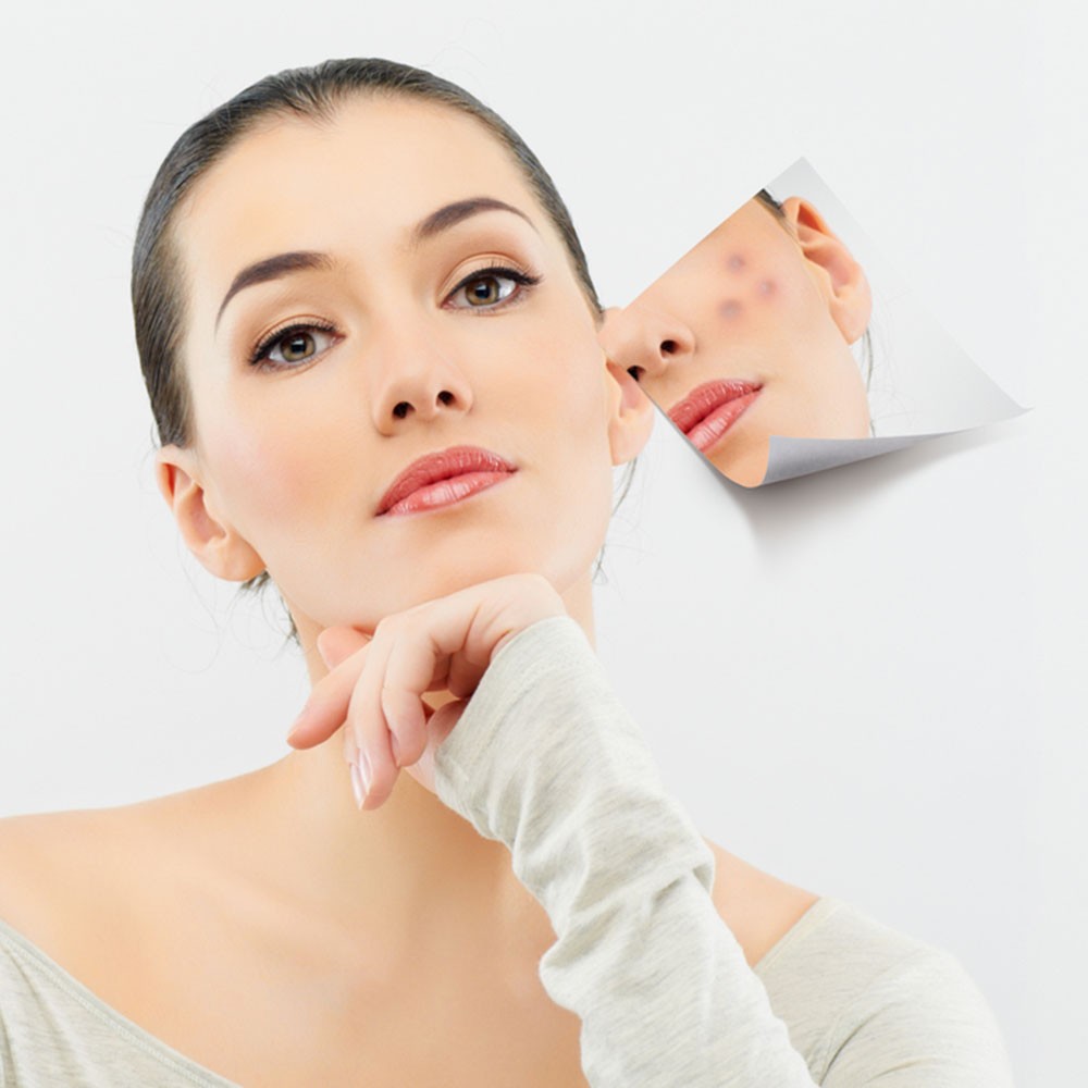 cách trị nám tốt