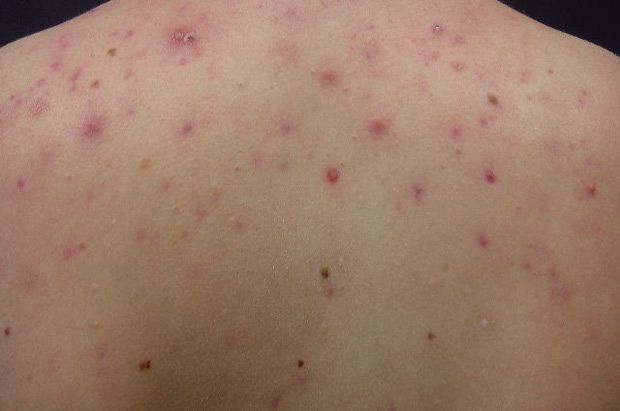 cách chữa viêm lỗ chân lông