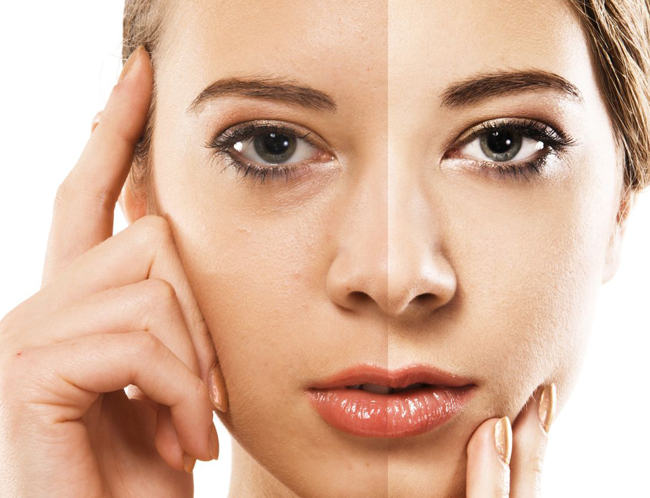 Kem trị nám tốt