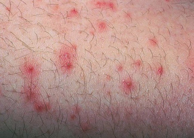 mẹo chữa viêm nang lông