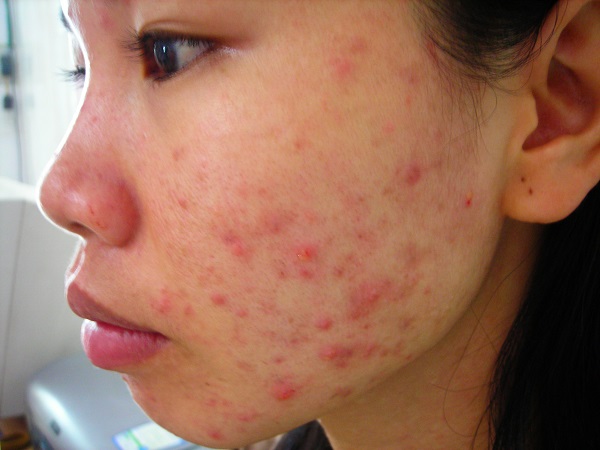 serum trị thâm