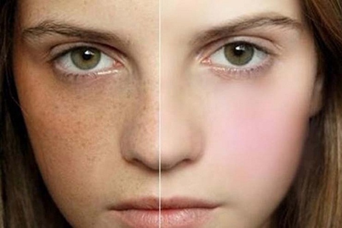 cách điều trị nám