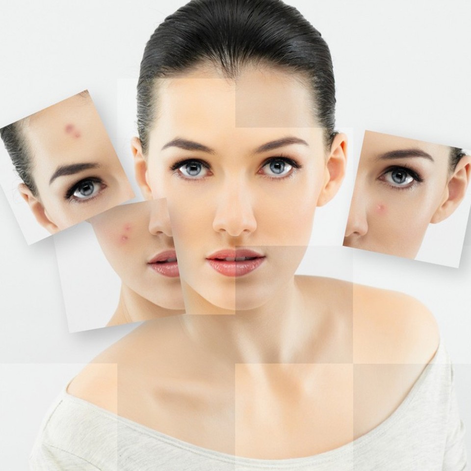 Kem chống nắng nào tốt nhất cho da mụn?