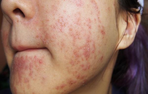 cách chữa viêm lỗ chân lông ở mặt 1