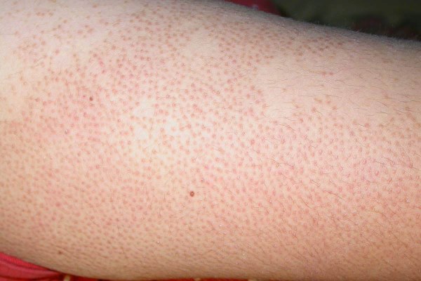 cách trị viêm lỗ chân lông