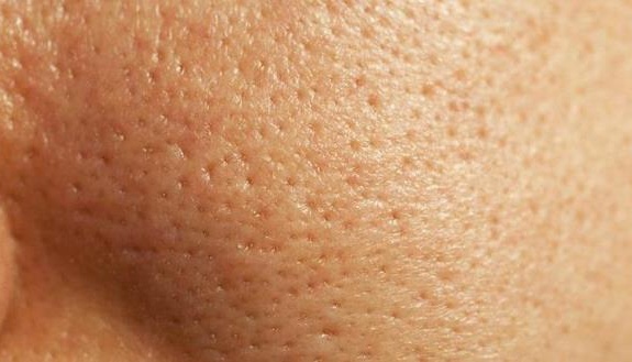 trị lỗ chân lông to