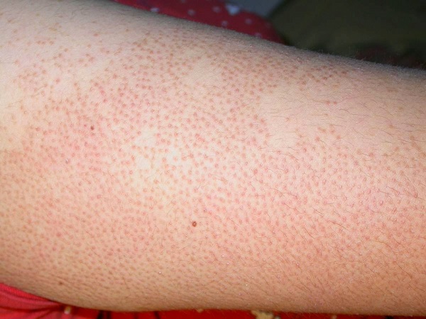 cách trị viêm lỗ chân lông 1