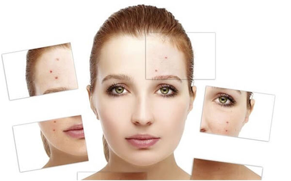 cách trị mụn an toàn cách trị mụn an toàn