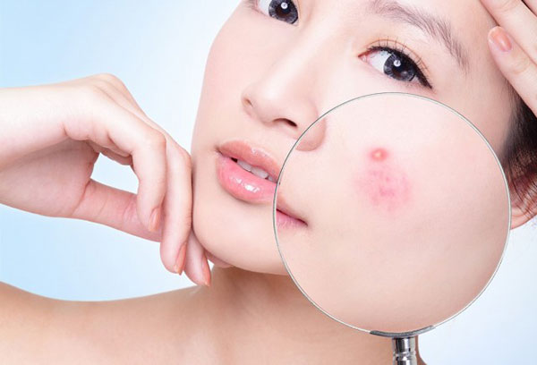 cách trị mụn hiệu quả