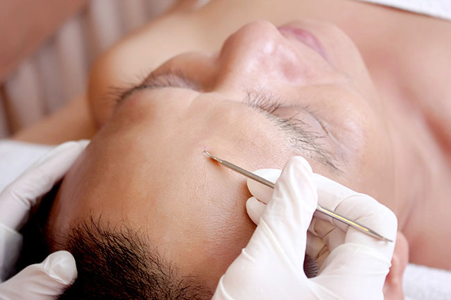 cách lấy nhân mụn cho da dầu cách lấy nhân mụn cho da dầu