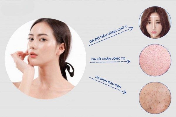 Chăm sóc da dầu mùa hè đúng chuẩn để ngăn ngừa những vấn đề về da