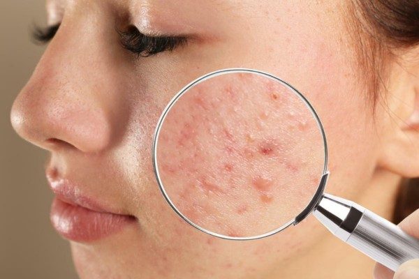Da dầu mụn nên đắp mặt nạ để kiềm dầu, ngăn ngừa và hỗ trợ trị mụn nhanh chóng