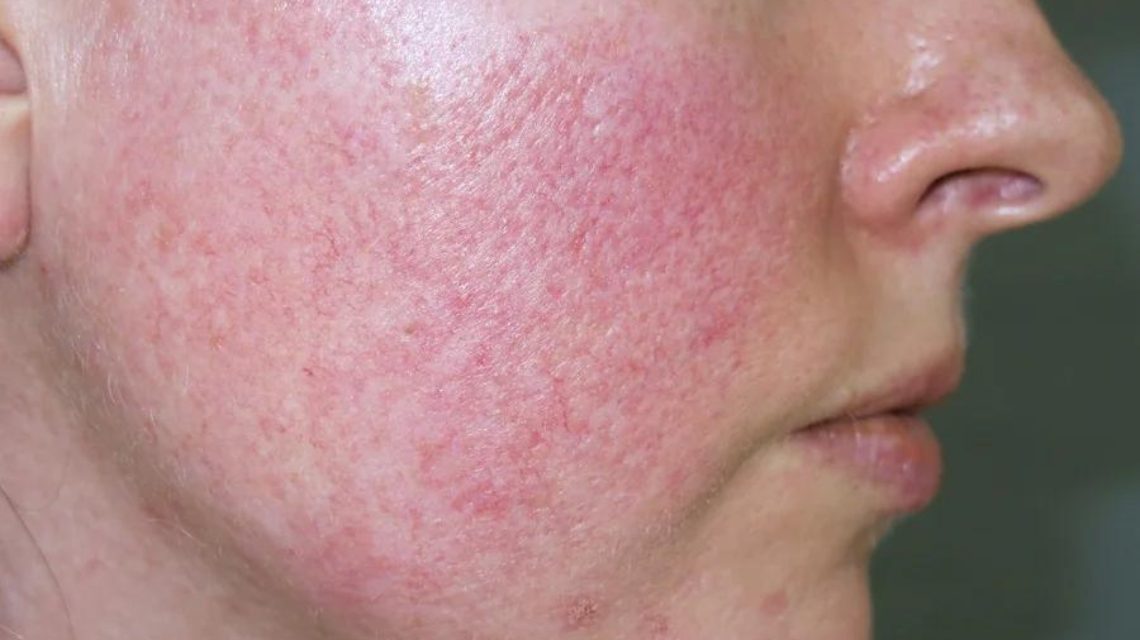 Bác sĩ có thể giúp xác định nguyên nhân chính xác và đề xuất phương pháp điều trị da giãn mao mạch phù hợp nhất.