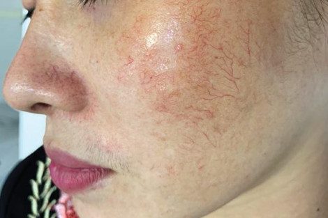 Giãn mao mạch da là gì? Hãy đến chuyên khoa da liễu hoặc cơ sở chăm sóc da uy tín để được tư vấn và khắc phục kịp thời