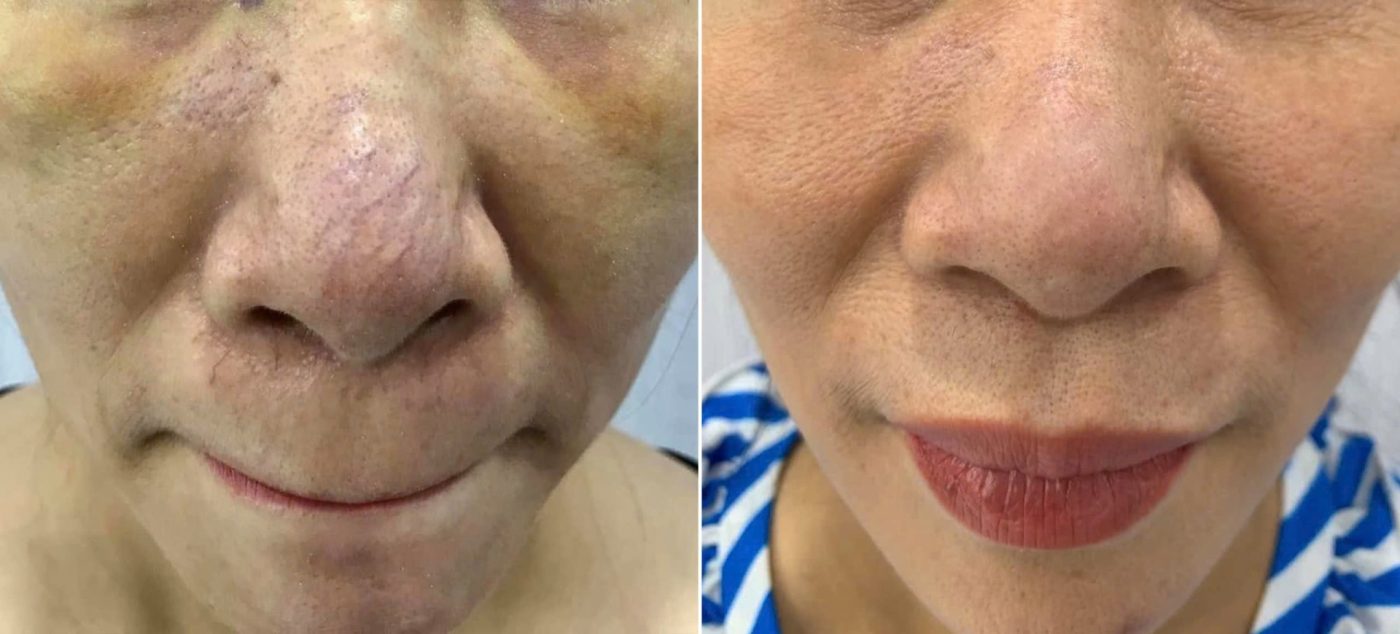 Tham khảo sản phẩm phục hồi nền da khỏe mạnh, hỗ trợ cải thiện giãn mao mạch mũi