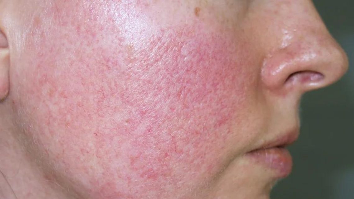 Hướng dẫn sử dụng kem phục hồi da giãn mao mạch đạt hiệu quả tối ưu