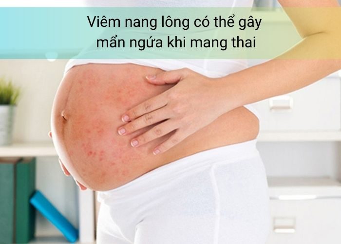Bà bầu bị viêm nang lông là tình trạng không hiếm gặp và có thể xuất phát từ nhiều yếu tố khác nhau. Hiểu rõ nguyên nhân giúp mẹ bầu chủ động hơn trong việc phòng ngừa và điều trị hiệu quả.