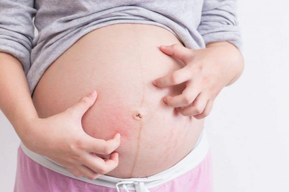 Nếu các phương pháp chăm sóc da bà bầu bị viêm nang lông tại nhà không hiệu quả, liệu có nên dùng thuốc bôi hay không?
