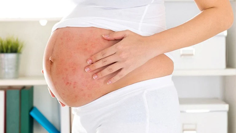 Ngoài ra, việc cạo lông, tẩy lông hay dùng các loại mỹ phẩm chứa corticoid, chất tạo mùi cũng tiềm ẩn nguy cơ khiến bà bầu bị viêm nang lông.