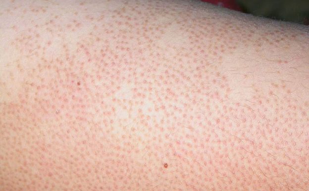 Nếu được chăm sóc đúng cách với các sản phẩm an toàn từ thiên nhiên như của Dr.Spiller, bạn có thể kiểm soát tình trạng bà bầu bị viêm nang lông một cách hiệu quả, đảm bảo sức khỏe làn da và sự phát triển ổn định của thai nhi.