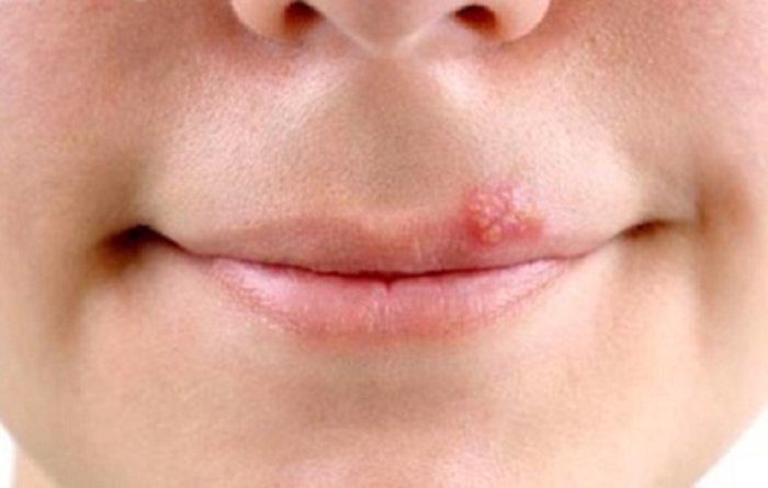 Một vài lưu ý khi chọn cách chữa mụn ở môi