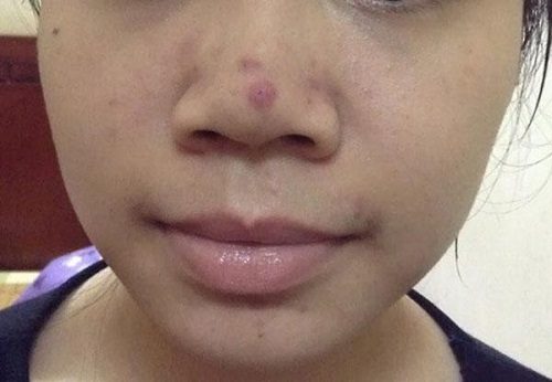 Cách làm hết mụn thâm ở mũi nào đem lại hiệu quả nhanh chóng