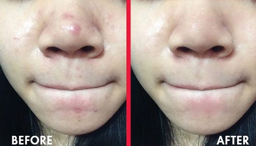 Các hoạt chất thường được sử dụng trong cách làm hết mụn thâm ở mũi