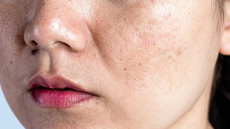 Những lưu ý khi áp dụng các cách ngăn ngừa nám sau sinh
