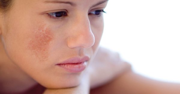 Cách ngăn ngừa nám sau sinh nào thường được áp dụng nhất hiện nay