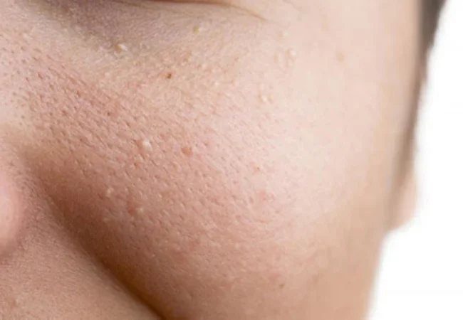 Một vài lưu ý khi áp dụng cách trị mụn ẩn ở má tại nhà