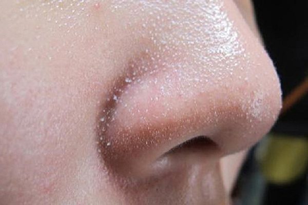 Tham khảo các cách trị mụn ẩn ở mũi phổ biến hiện nay