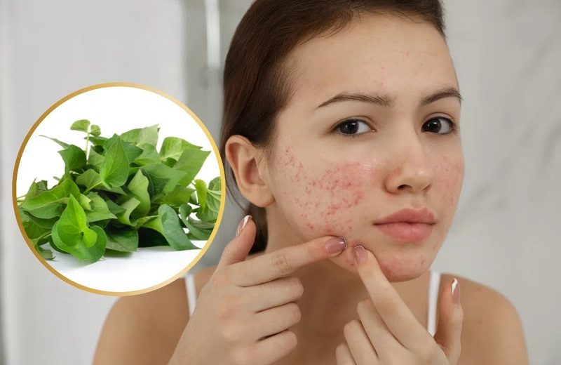 5 Cách trị mụn bọc bằng rau diếp cá phổ biến hiện nay