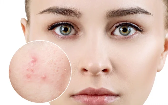 Những cách trị mụn cho da nhạy cảm phổ biến hiện nay
