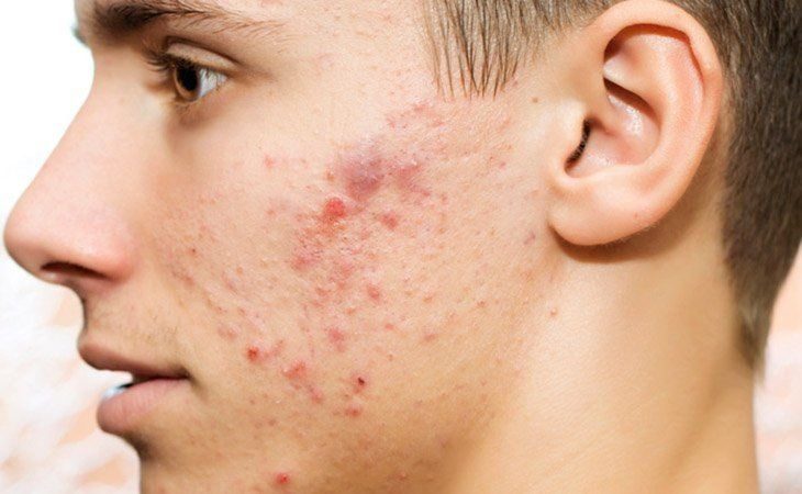 Những cách trị mụn do nội tiết tố nam phổ biến hiện nay