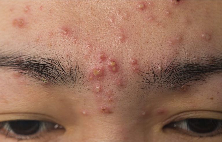 Hiểu rõ nguyên nhân để có cách trị mụn mủ ở mặt hiệu quả