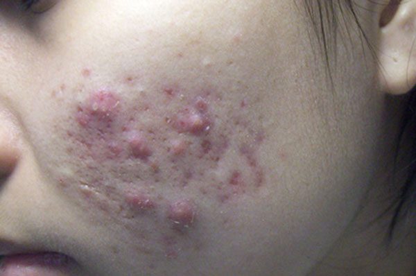 Những lưu ý khi chọn cách trị mụn ở mặt