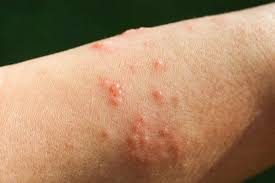 Cách trị mụn nước từ giai đoạn phòng ngừa