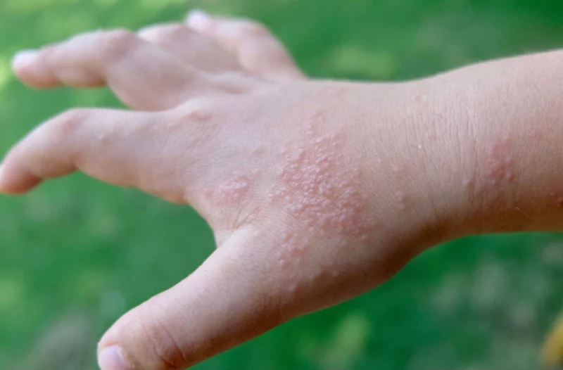 Cách trị mụn nước khi chúng lan quá nhanh là bạn nên đến bác sĩ thăm khám ngay