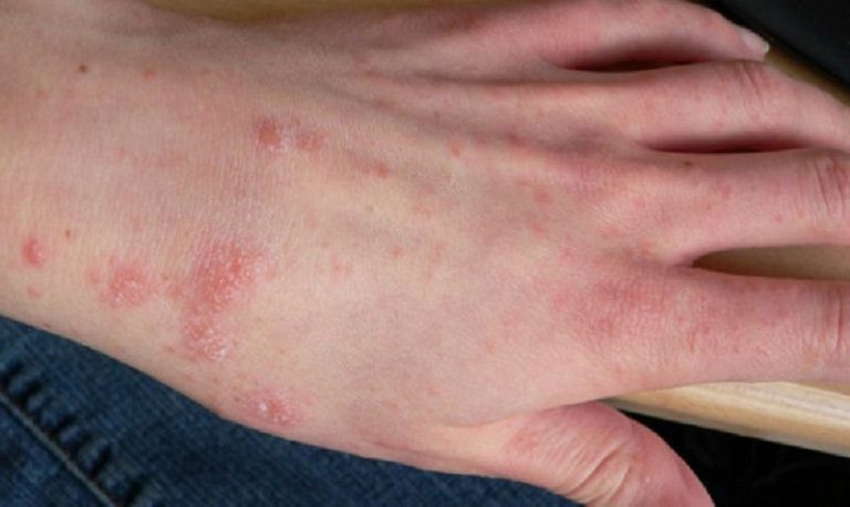 Tìm hiểu nguyên nhân để có cách trị mụn nước hiệu quả