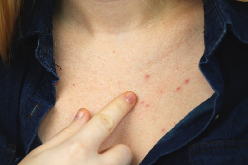 Những lưu ý khi chọn cách trị mụn trứng cá ở ngực