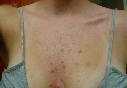 Hiểu rõ nguyên nhân bạn sẽ chọn được cách trị mụn trứng cá ở ngực hiệu quả