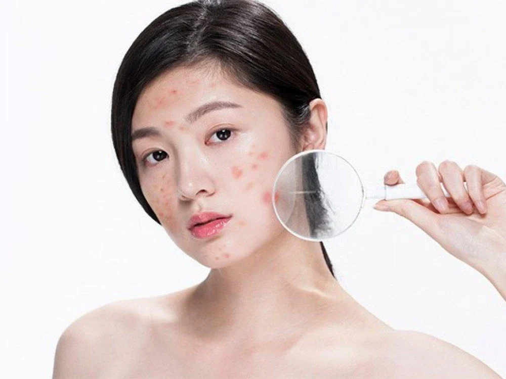 Những lưu ý khi chọn cách trị mụn tuổi dậy thì