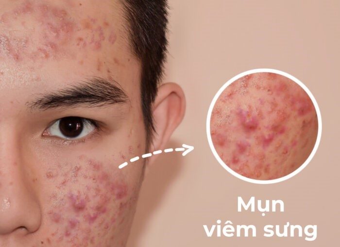 Hiểu rõ nguyên nhân để có cách trị mụn viêm phù hợp