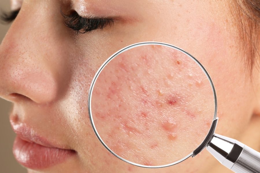 Những cách trị mụn viêm chuyên sâu thường được dùng tại spa